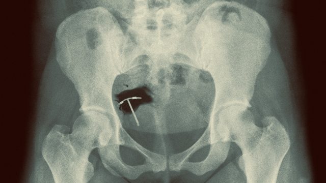 The dark side of the contraceptive coil