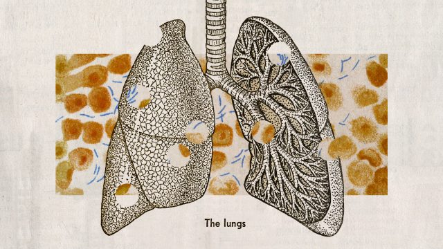 Tuberculosis sees a resurgence and is only going to get worse