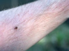 Alpha-gal syndrome causes uptick in meat allergies