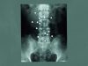 Microrobots that could heal spinal injuries