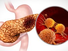 Pill offers hope in treating deadly pancreatic cancer