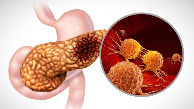 Pill offers hope in treating deadly pancreatic cancer